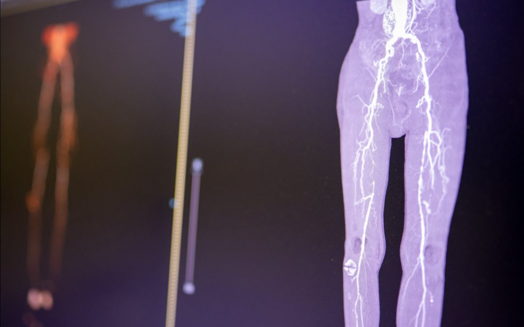 Early Champions For Peripheral Vascular Technology